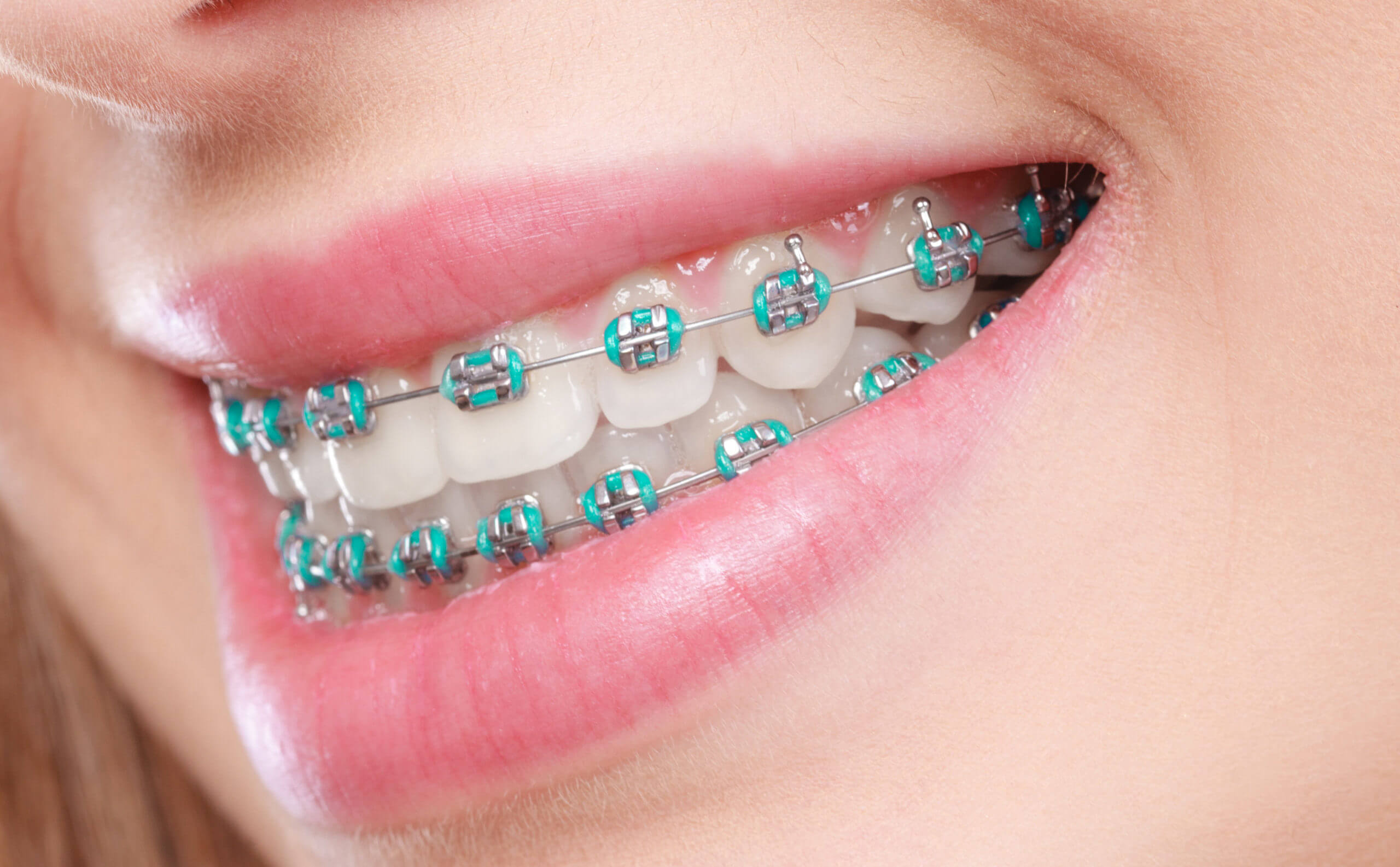 Removable Braces for Adults in the UK: A Complete Guide to Invisalign & Clear Aligners