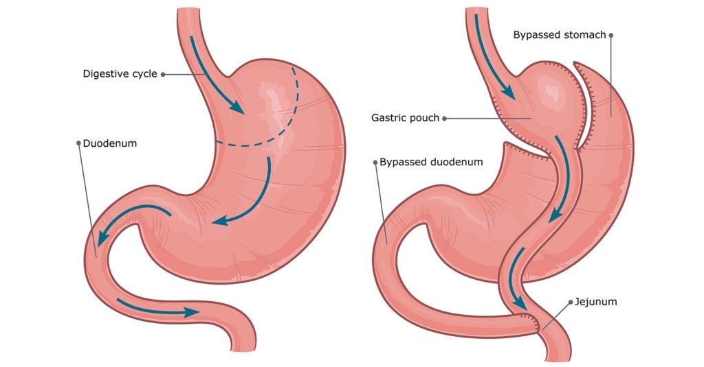 Gastric Bypass Surgery Guide: Procedure, Eligibility, Risks & Alternatives for Weight Loss