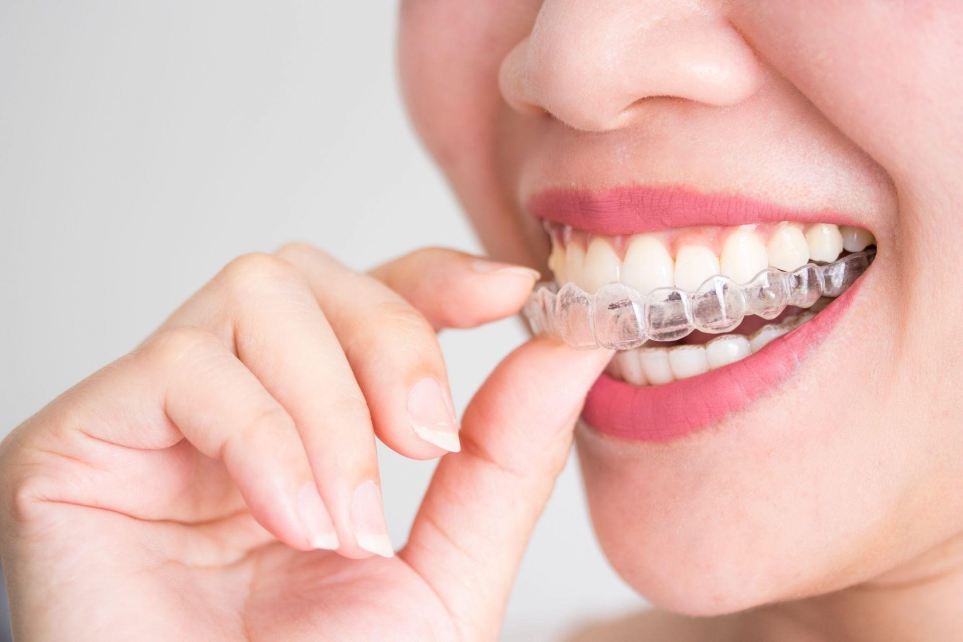 Invisible Teeth Aligners: A Clear Path to a Straighter Smile – Benefits, Costs & Trends