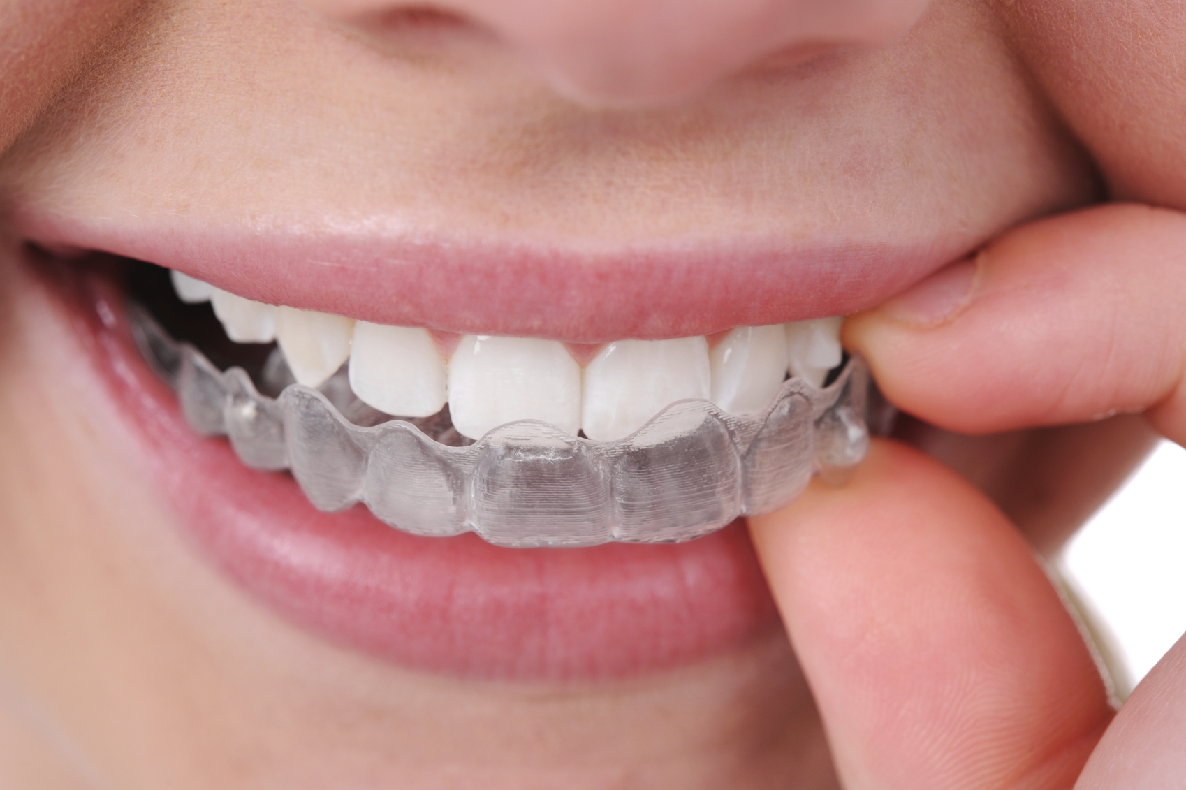 Braces and Dental Splints in the UK: Types, Costs, and Innovations