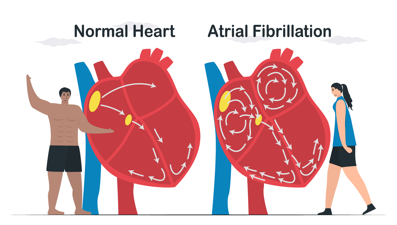 Atrial Fibrillation Explained: Symptoms, Triggers, Prevention & Treatment Options