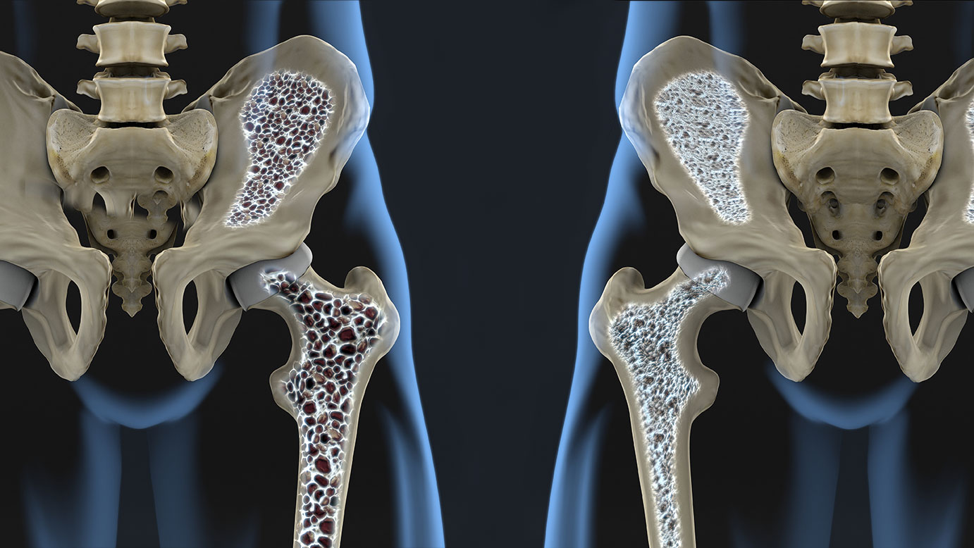 Bone Density Treatments: From Prevention to Advanced Therapies – A Complete Guide