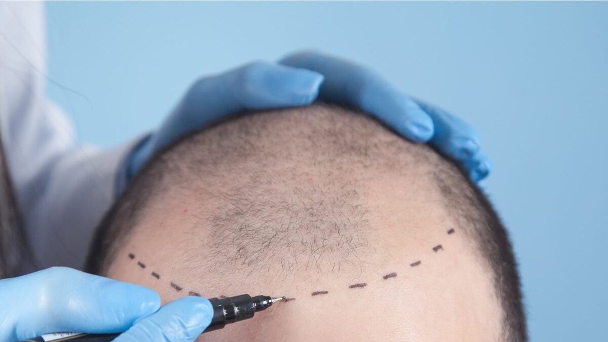 Haartransplantation in Deutschland: Kosten, Techniken und Klinikvergleich