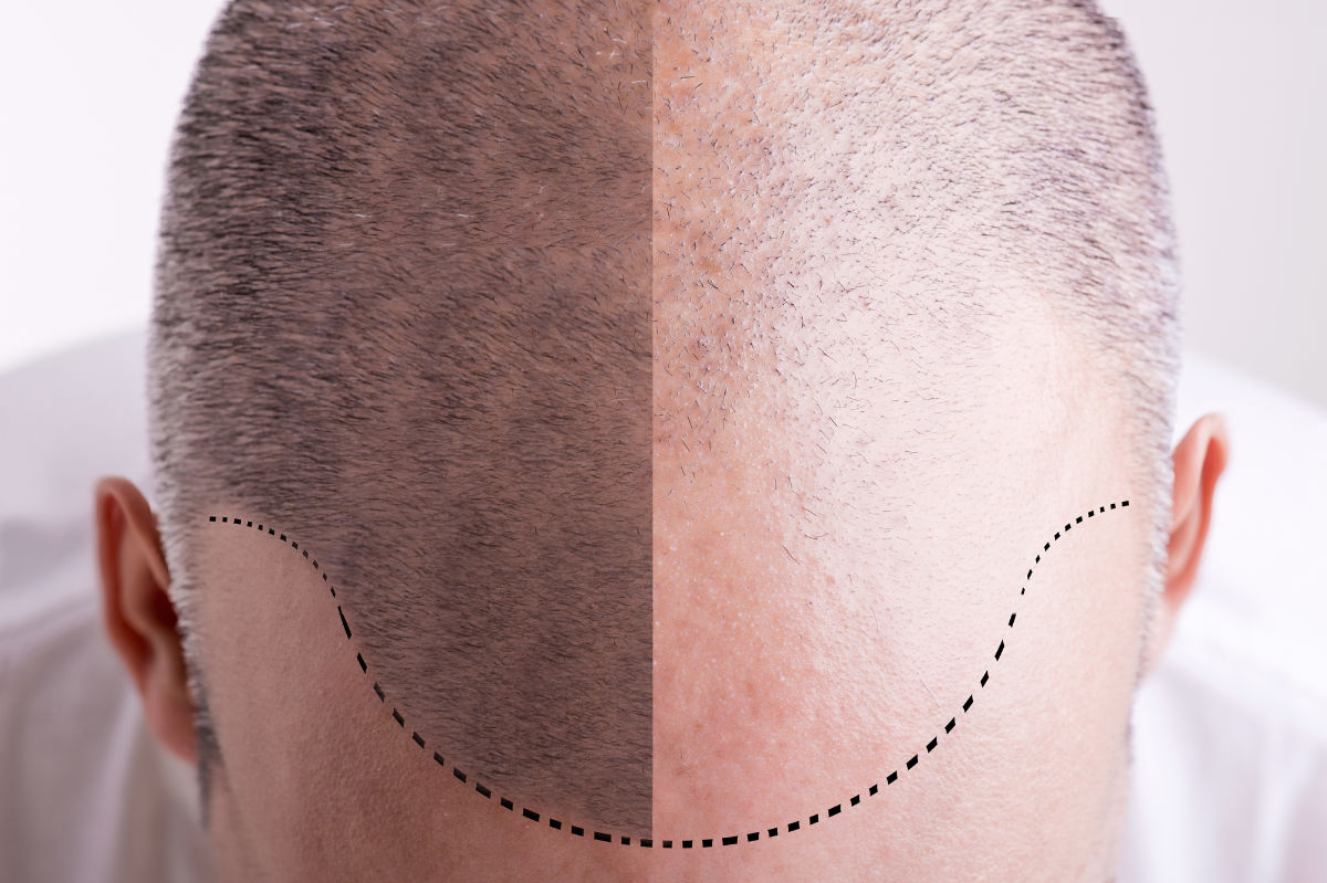 UK Hair Transplant Costs 2024: FUE vs FUT Pricing & Clinic Selection Guide