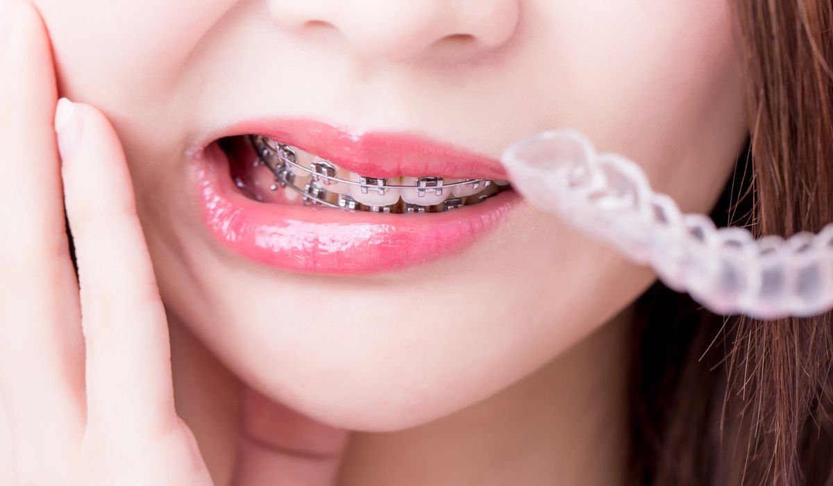Complete Guide to Braces in the US: Types, Costs, Treatment & More