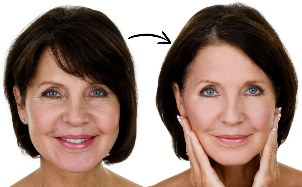 Lifting Facial: Cirugía vs Alternativas No Invasivas para un Rejuvenecimiento Natural