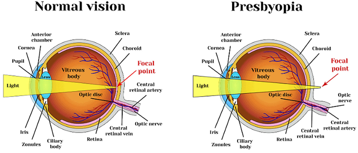 Modern Presbyopia Treatments: Eyeglasses, Contacts, Surgery & Eye Drops