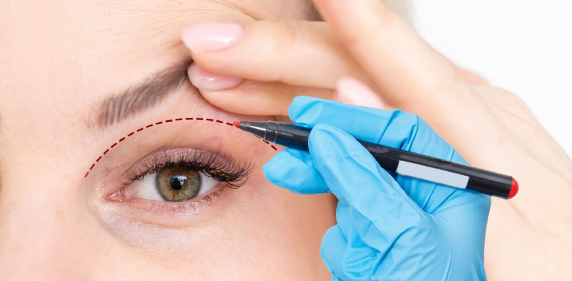 Blefaroplastia Láser: Resultados Naturales y Recuperación Acelerada