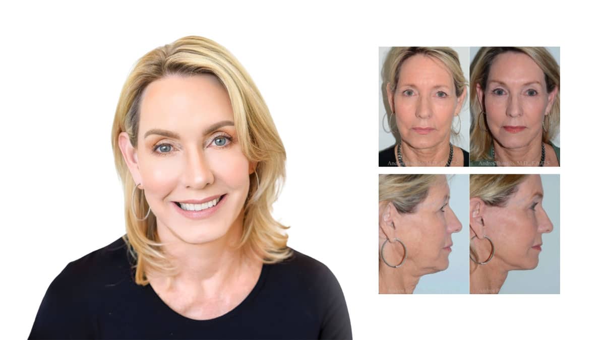 Modern Facelift Guide: Natural Rejuvenation Options & Costs
