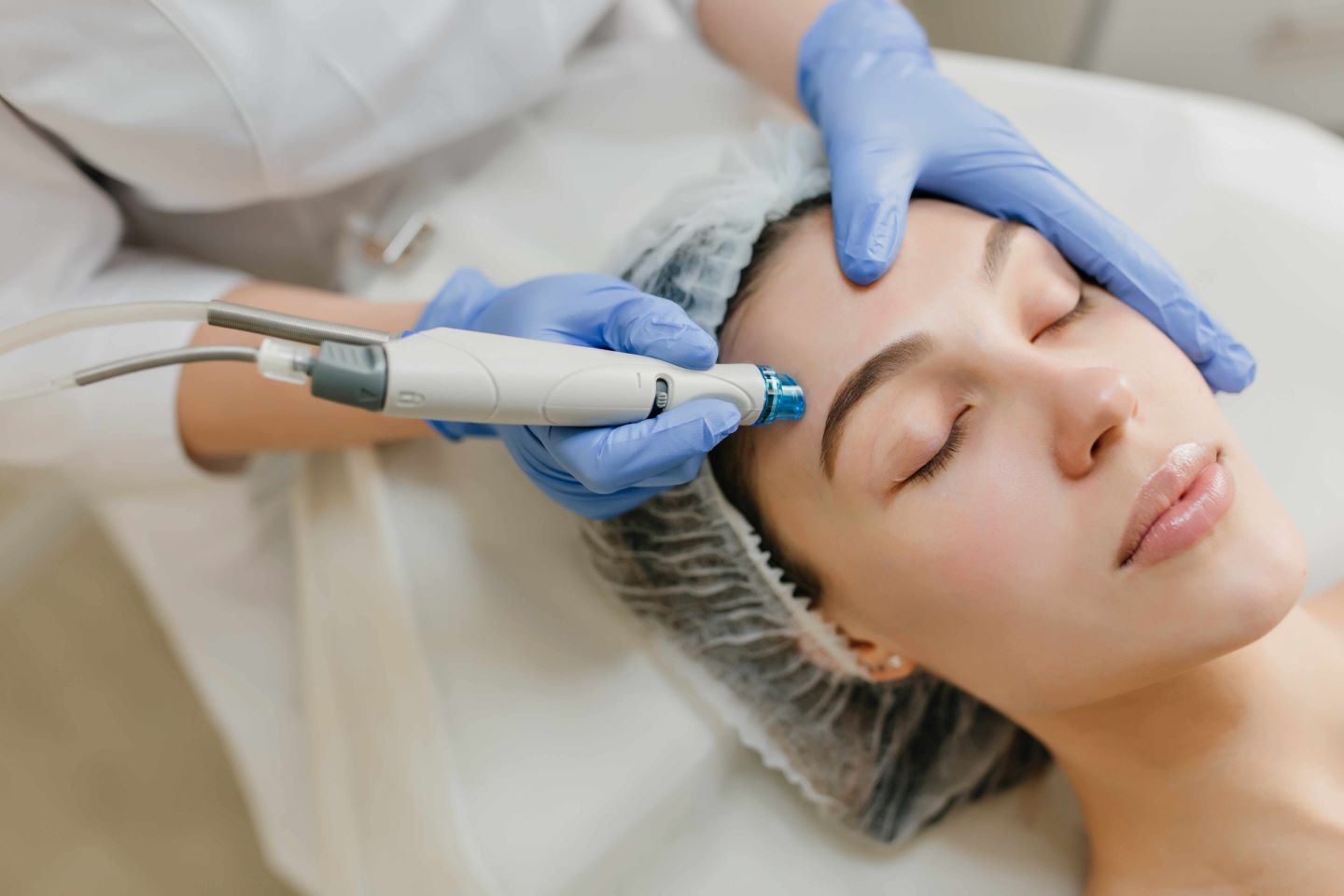 Microneedling : le guide complet pour une peau transformée et rajeunie