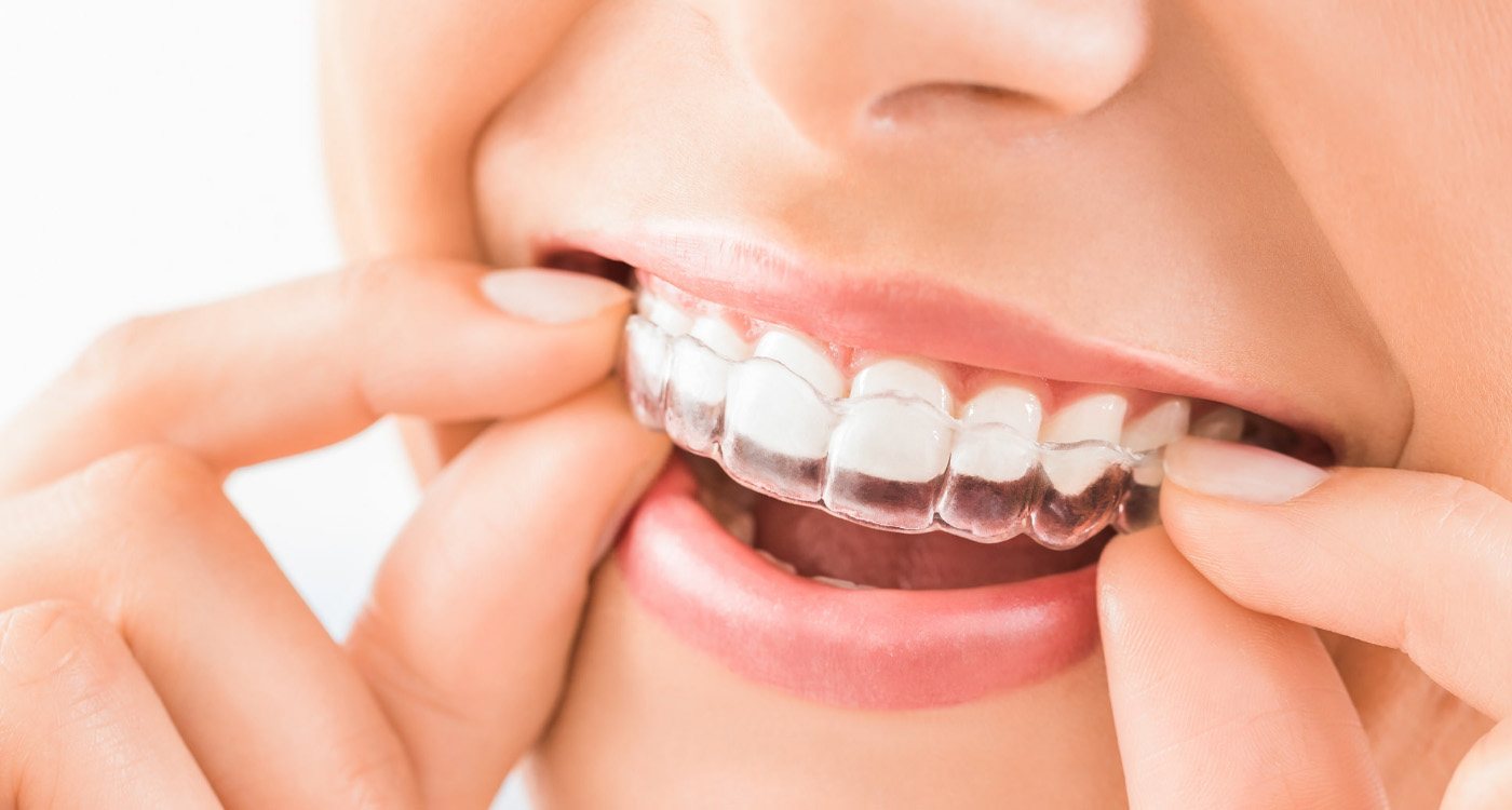 Clear Teeth Alignment: Affordable Options and the Need for Professional Oversight