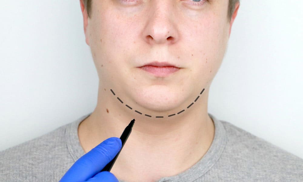 Láser para Eliminar Papada Sin Cirugía: Solución No Invasiva para Hombres y Mujeres
