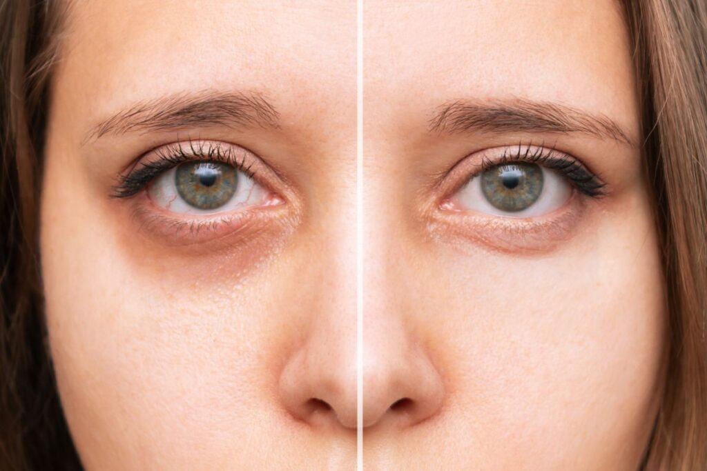 Laser Under-Eye Treatment: From Dark Circles to Firm Skin – A Complete Guide