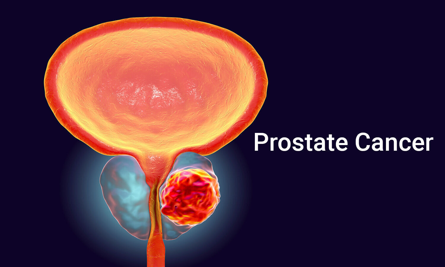 Advanced Prostate Cancer Treatments: From Hormone Therapy to CAR-T and Radioligand Therapy