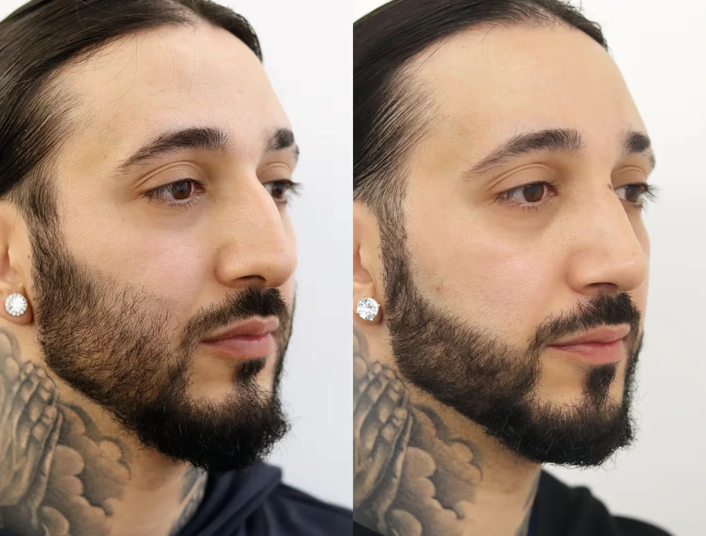 Modern Male Rhinoplasty: Aesthetics, Function, and Recovery Insights