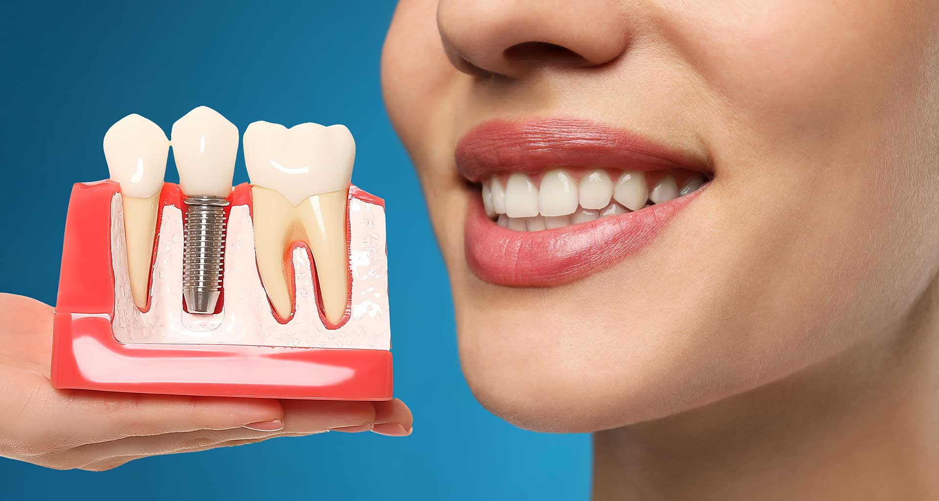 Implant dentaire : prix, étapes et remboursement en France – Guide complet