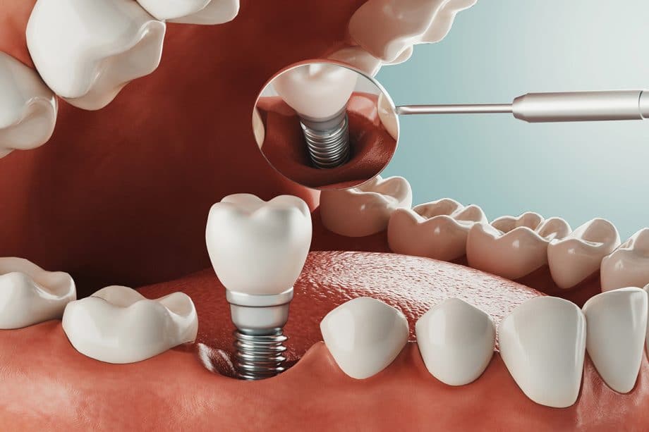Impianti Dentali: Guida Completa a Costi, Tipologie e Vantaggi