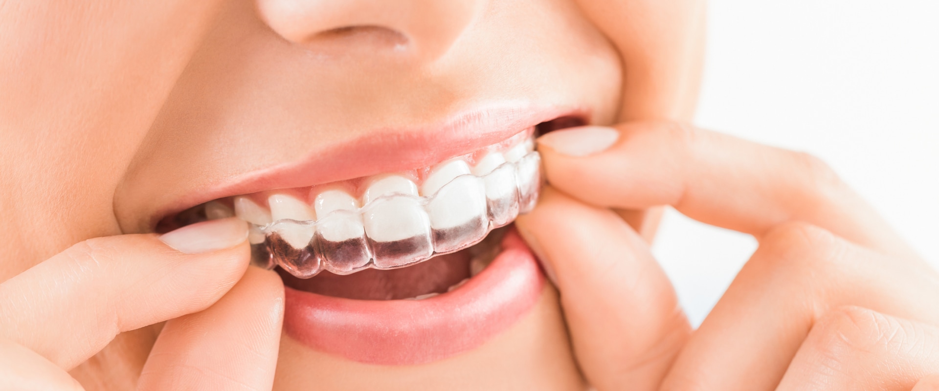 Invisalign vs Braces: Benefits, Cost, and How It Works – Complete Guide