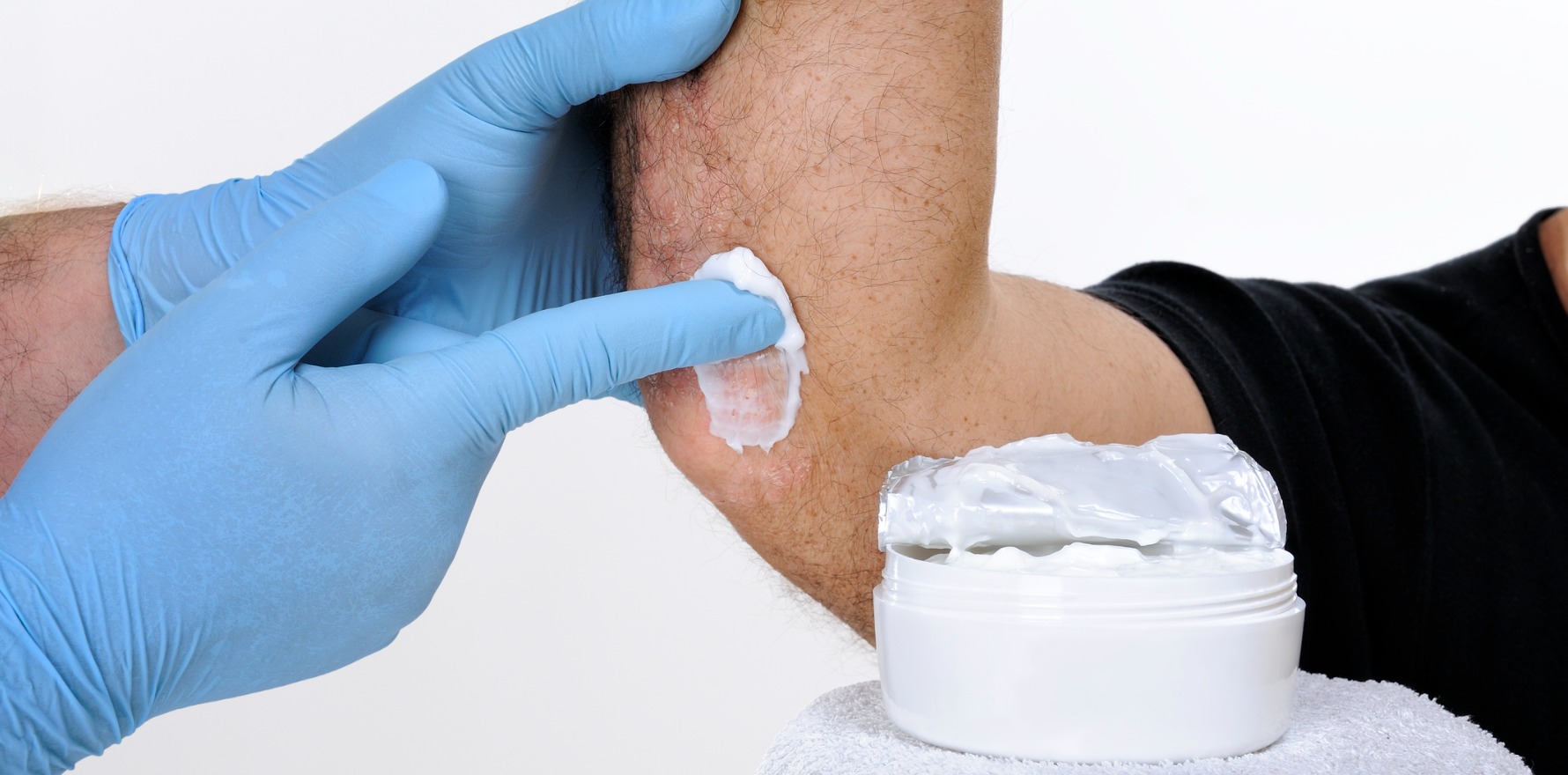 Psoriasis: Triggers, Symptoms, Types, and Effective Management Strategies