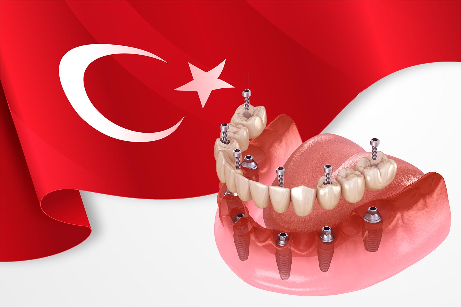 Why Brits Are Choosing Turkey for Dental Implants: Costs, Care & Travel Tips