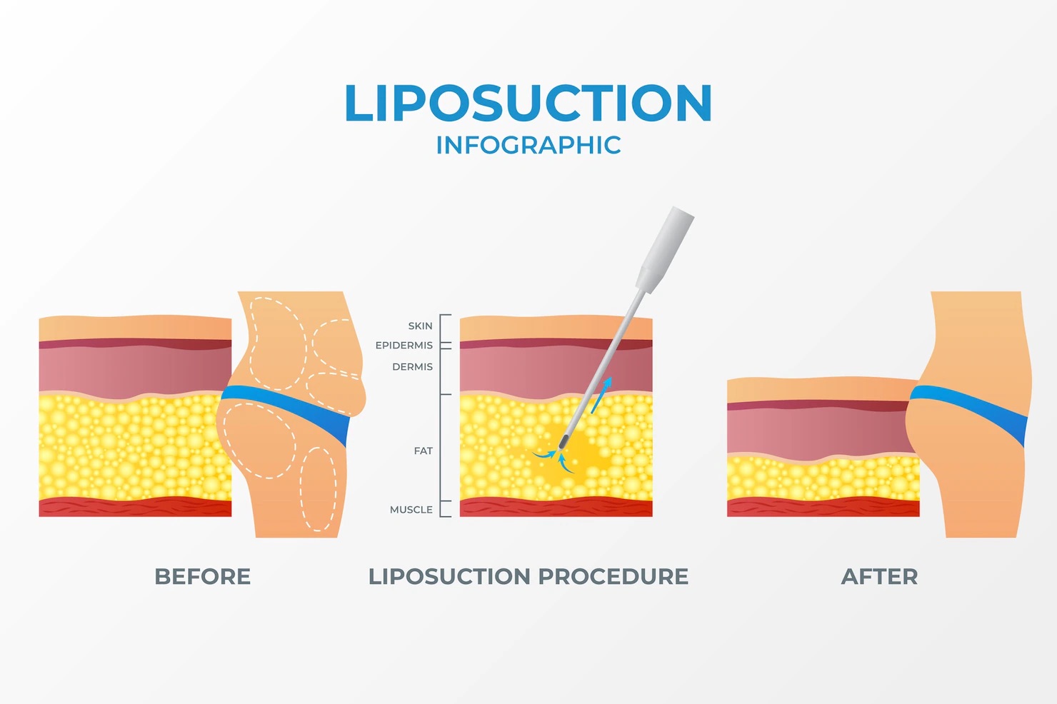 Liposuction UK 2024: Costs, Types, and Non-Surgical Alternatives Explained