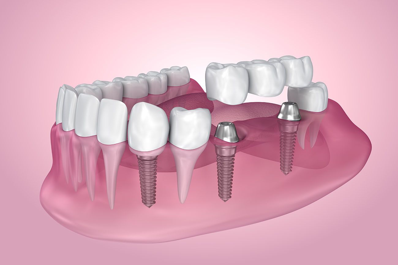 Dental Implants: A Complete Guide to Restoring Missing Teeth and Your Smile