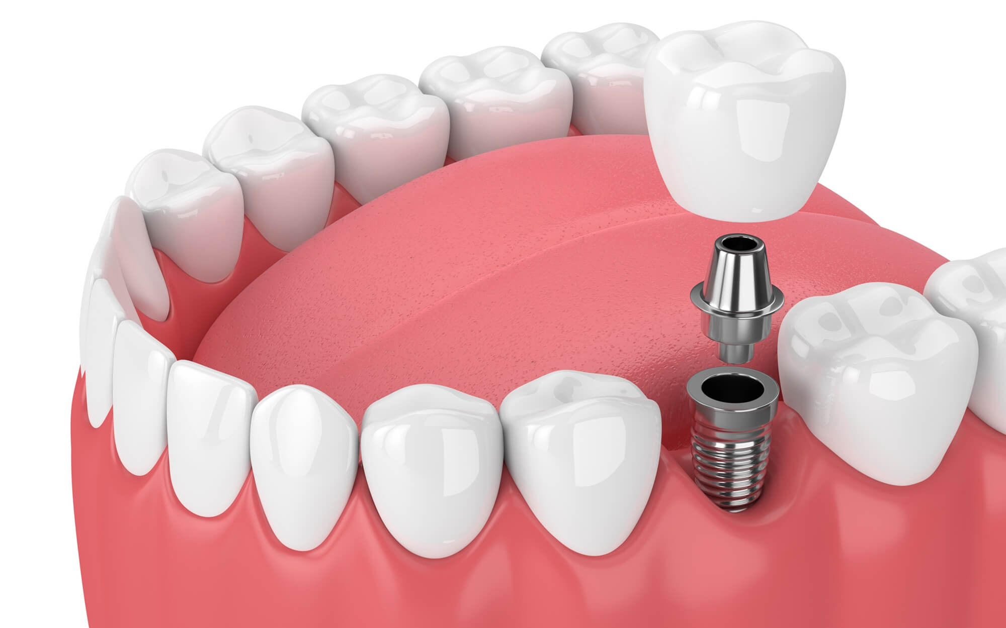Your Guide to Dental Implants: Procedure, Costs, and Finding a Local Specialist
